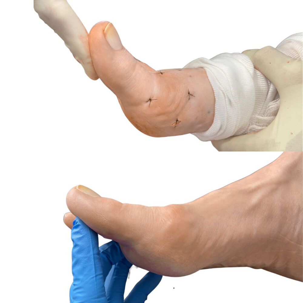 Hallux Limitus / Rigidus CDA Foot and Ankle