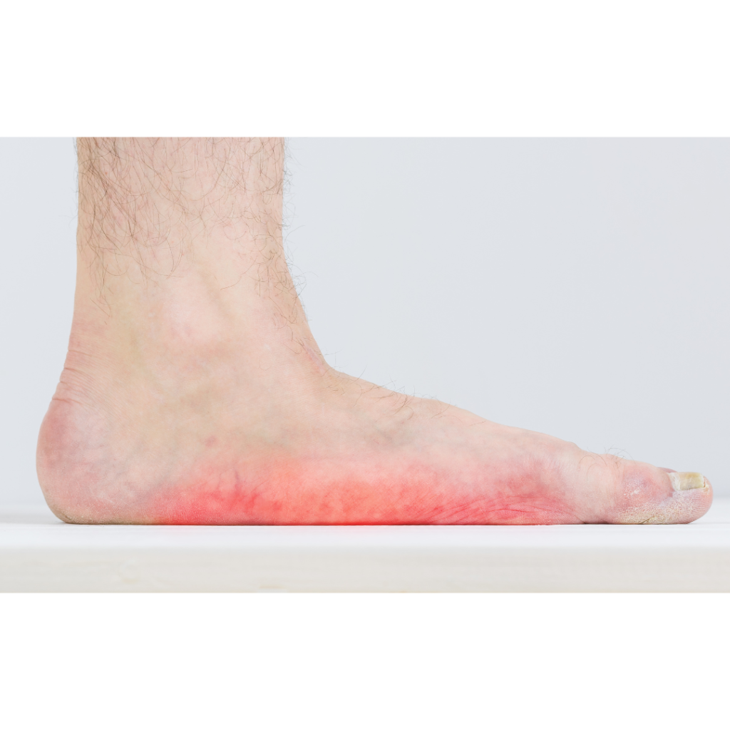 Flat Feet CDA Foot and Ankle